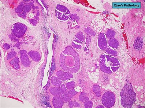 Qiao S Pathology Pleomorphic Lobular Carcinoma In Situ P Flickr