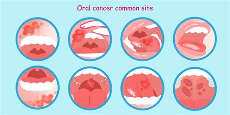 How Oral Cancer Screening Work Bradenton FL 3D Dentistry