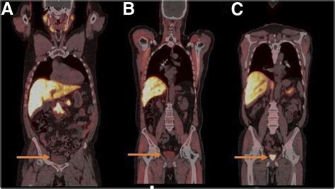 Axumin Pet Scan Indications Danyelle Mooney