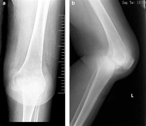 A Anteroposterior And B Lateral Radiographs Demonstrate Posterior