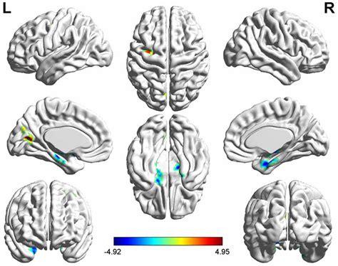 Frontiers Aberrant Brain Function In Active Stage Ulcerative Colitis