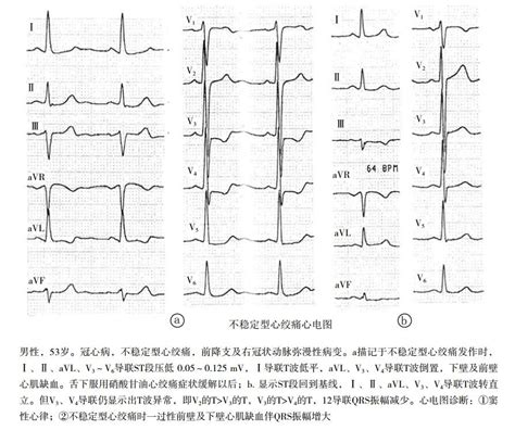 【附图】 心绞痛综合征 心血管综合征学 天山医学院