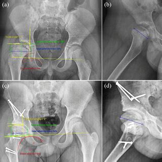 Improvement of Stulberg classification at the follow-up | Download ...