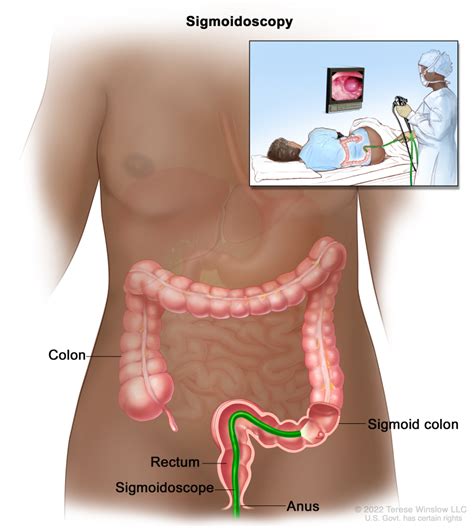 Colon Cancer Treatment PDQ PDQ Cancer Information Summaries NCBI