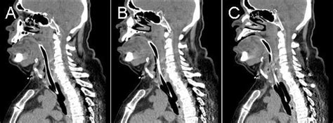 representative lateral images   neck ct scan