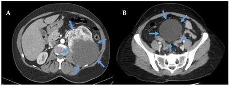 Current Oncology Free Full Text Practical Management Of Adult Ultra