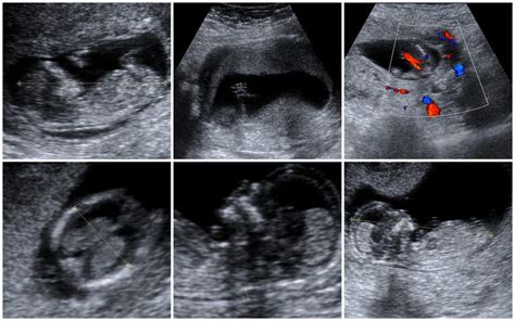 Colour Doppler Ultrasound Price What Is It Medium