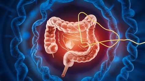 Illustration D De L Ablation D Un Polype Du C Lon Avec Une Boucle De