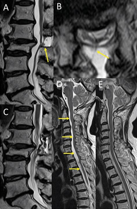 Figure From A Case Of Dural Herniation Of The Cauda Equina Caused By