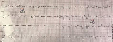 ECG Basics Fundamentals Criteria For Low Voltage QRS Complexes And