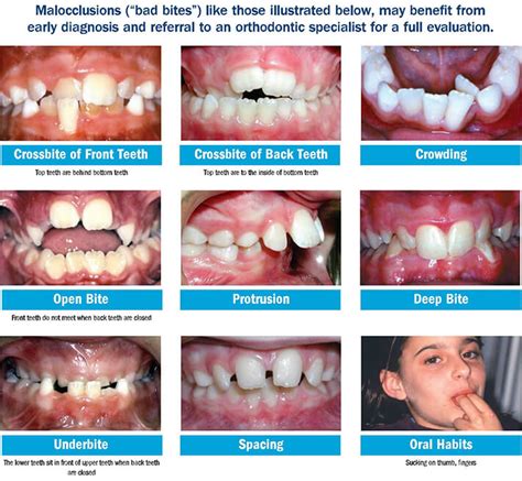 Early Phase 1 Braces Treatment Columbus Polaris Orthodontic Center