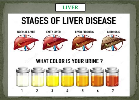 Liver Damage Urine Color - Infoupdate.org