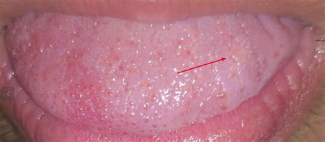 Is this an HPV tongue wart ? : r/HPV