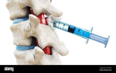 Spinal Anesthesia Stockfotos Und Bilder Kaufen Alamy