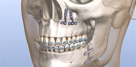 Jaw Realignment And Orthognathics Services Dr Leon Gillman BDS MFDS