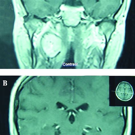 Contrast Enhanced Neck Ct Scan Axial View A Soft Tissue Mass 17 × Download Scientific