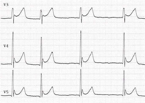 Osborn Wave J Wave Litfl Ecg Library Basics In Ecg