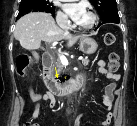 A Rare Complication Of The Duodenal Diverticulum Frontline