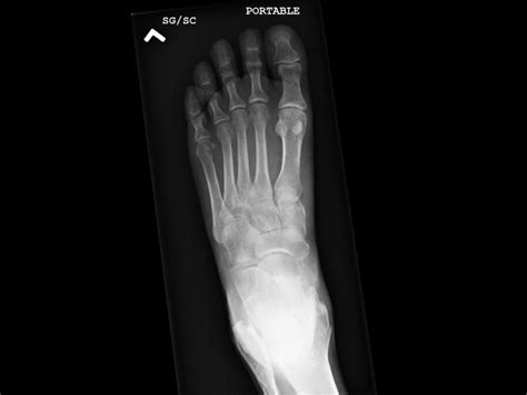 Ortho Dx What Is The Best Treatment For This Foot Injury Clinical