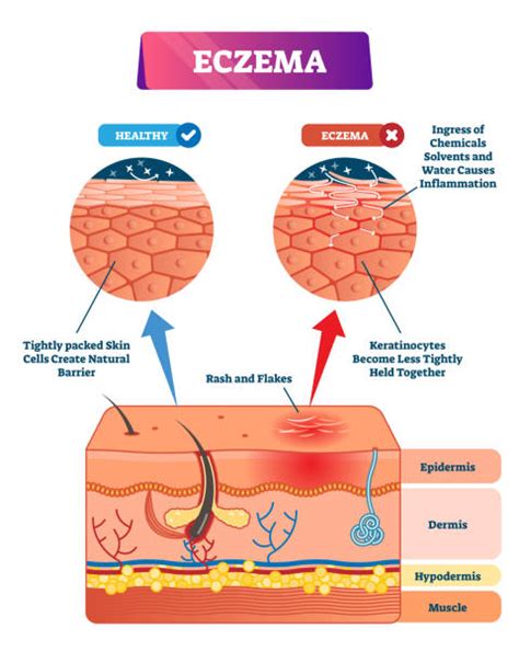 Eczema Charts