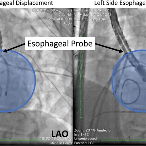 Approaches To The Diagnosis And Management Of Atrial Esophageal Fistula