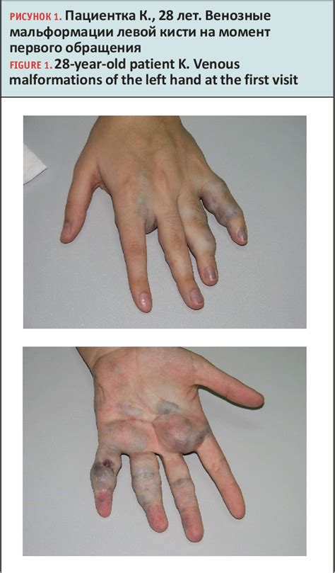 Figure From Microfoam Sclerotherapy Of Superficial Venous