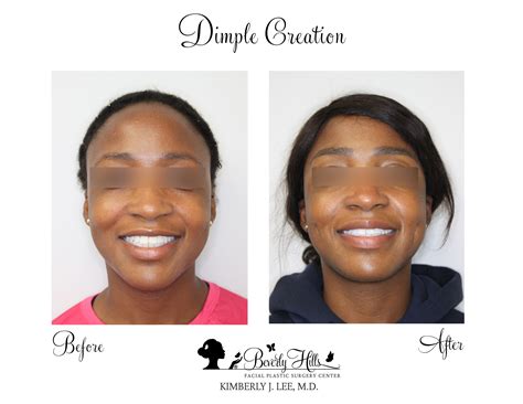 Dimple Creation Before & After Photos | Dr. Kimberly Lee