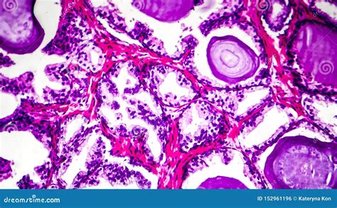 Histopathology Of Prostate Gland Hyperplasia Stock Photo Image Of