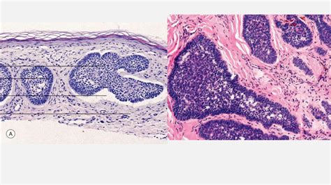 Carcinoma Basocelular Espinocelular Y Su Tratamiento Ppt