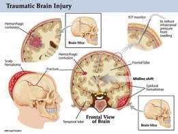 Traumatic Brain Injury Tbi Intensive Care Hotline