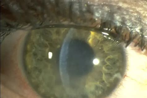 Herpes Simplex Keratitis Europe American Academy Of Ophthalmology