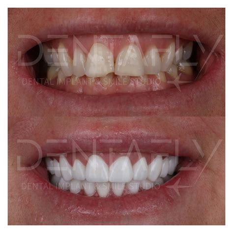 Zirconium Crown Before After Photos In Turkey