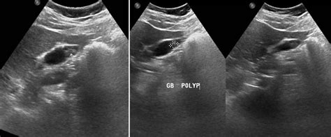 Gallbladder polyp – Radiology Cases