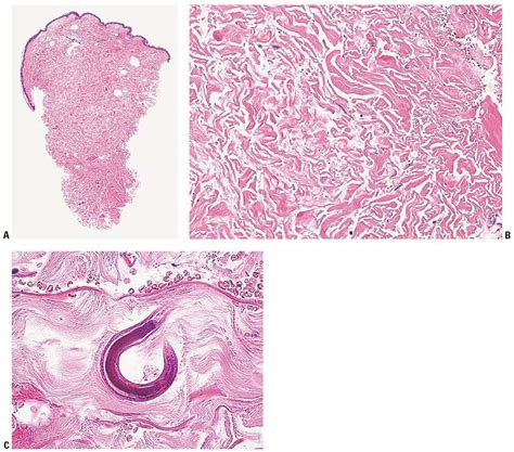 Protozoan Diseases And Parasitic Infestations Plastic Surgery Key