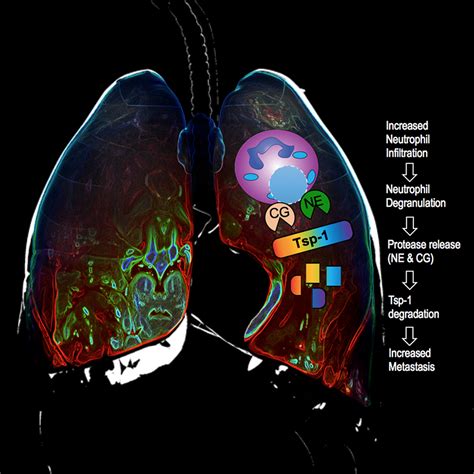 Lung inflammation contributes to metastasis