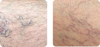 Harvard Trained Vein Doctor Things To Know Before And After Spider