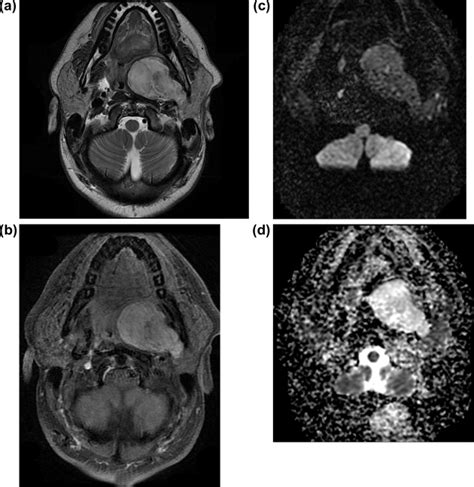 Parotid Gland Pleomorphic Adenoma A Axial T Weighted Spin Echo Mr