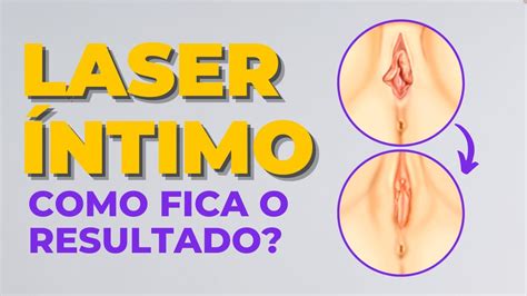 Como Fica O Resultado Do Laser Ntimo Youtube