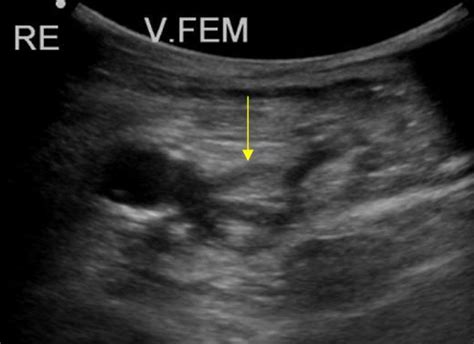 Peripheral vessels | 10.2 Peripheral veins : Case 10.2.1 Pelvic veins ...