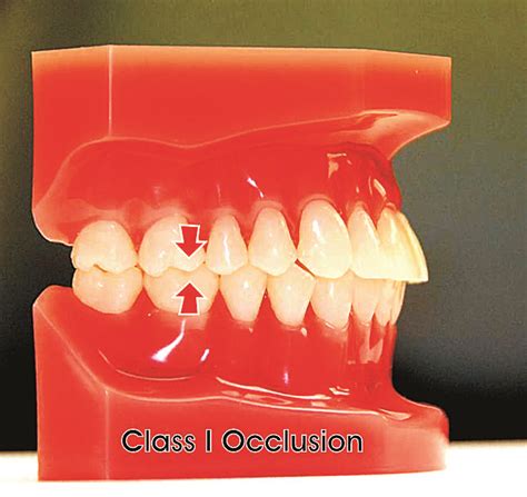 What Are The Types Of Malocclusions Ask An