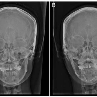 Radiographic Findings Of Case A Pre Operation And B Post Operation