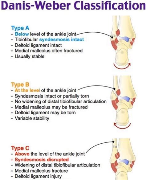 Weber classification of ankle fractures – Artofit