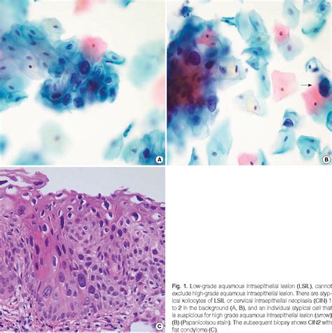 Low Grade Squamous Intraepithelial Lesion Renew Physical Therapy