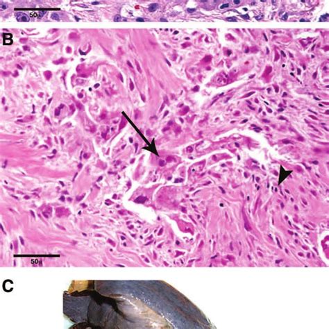 A Endobronchial Biopsy Showing Invasive Squamous Cell Carcinoma Scale