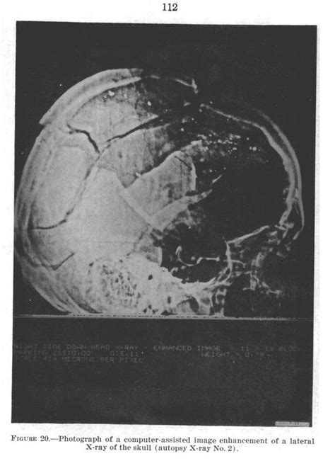 Neuropathologist: JFK's Head Wound Explained