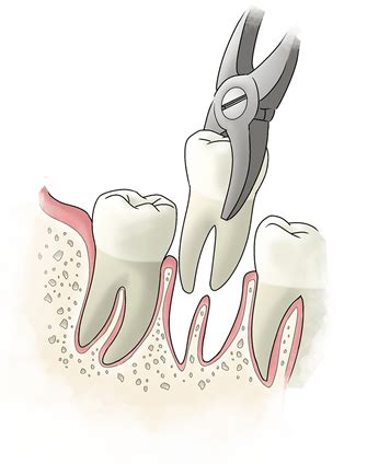 Type Of Extractions Rainbow Dental Centre