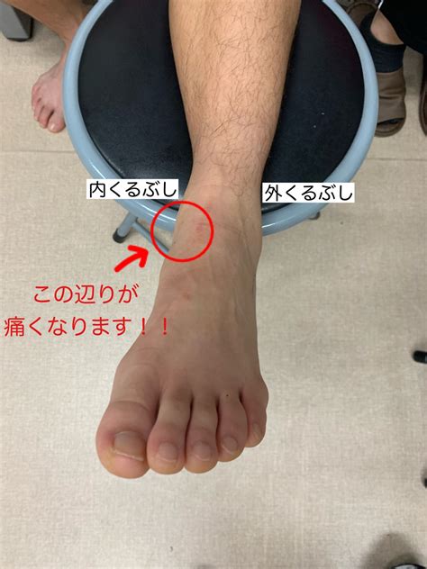 足首を捻って、内くるぶしの下の方が痛む。そんな時は、足の三角靭帯損傷があるかも、、、 長崎市のはしぐち整骨院｜日曜営業・交通事故治療・足底筋膜炎