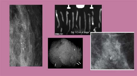 Biopsias Percutaneas 2 Para Temas Oncologicos Pptx