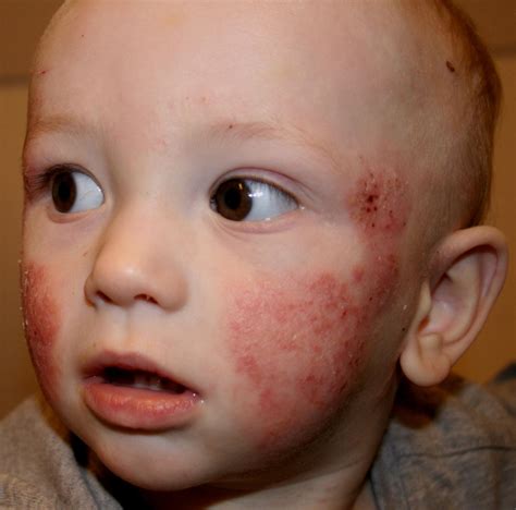 Colorado Springs Naturopathic Doctor Children And Eczema A Natural