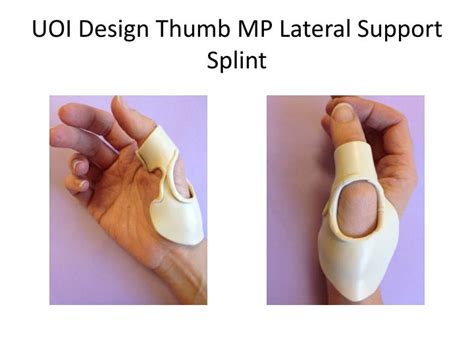 PPT - Innovative Splinting options for the Thumb MP joint PowerPoint ...